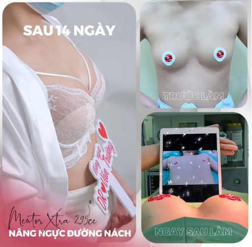 Nâng ngực qua đường nách