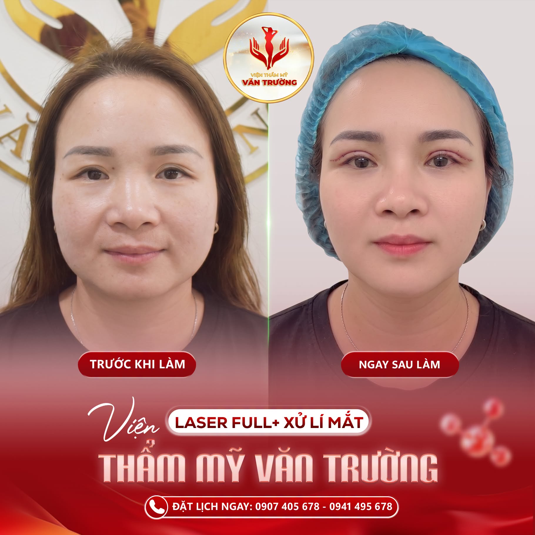 Sửa mí hỏng