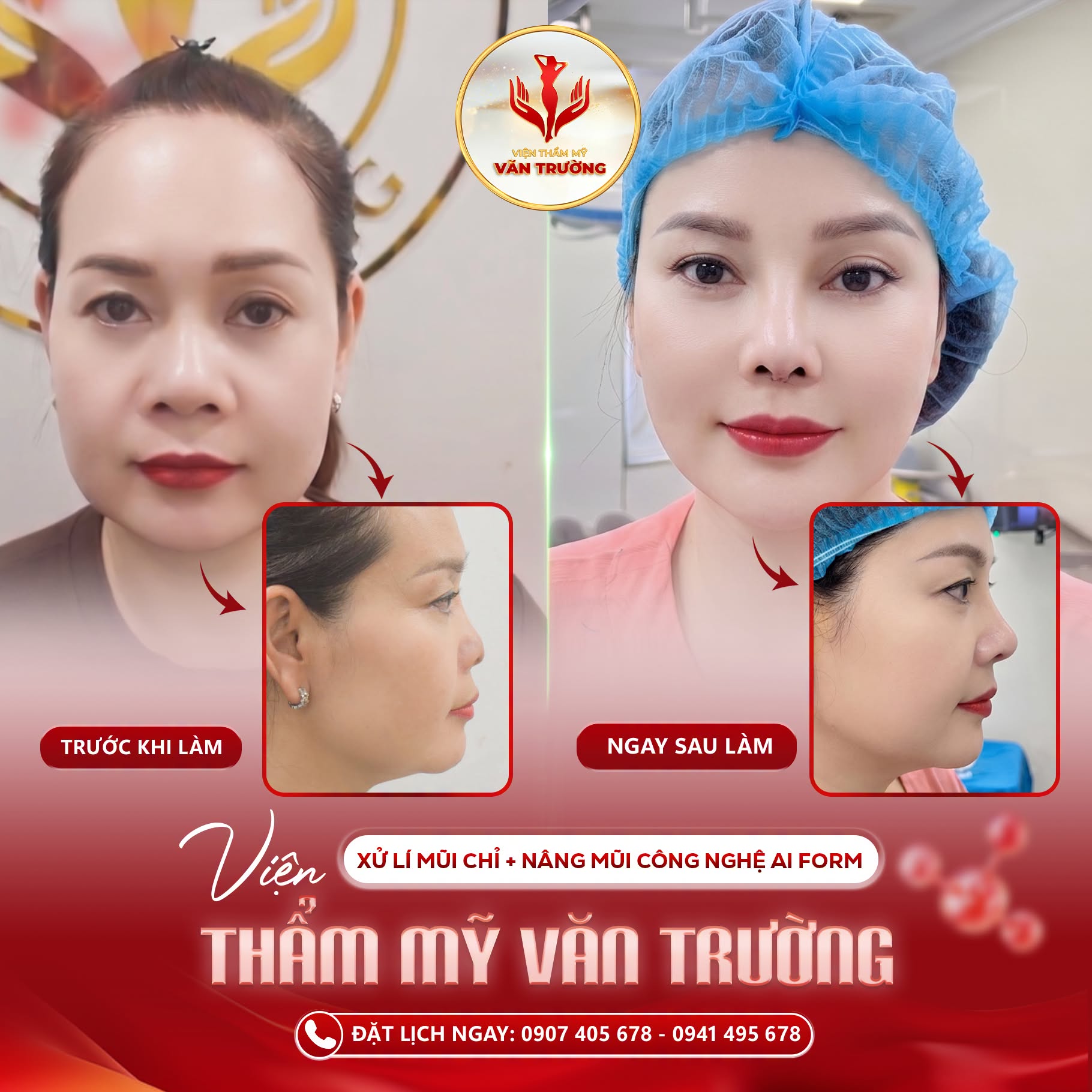 xử lý mũi