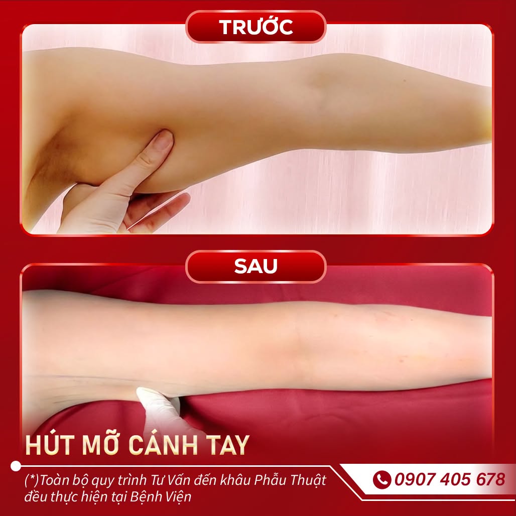 hút mỡ cánh tay 1