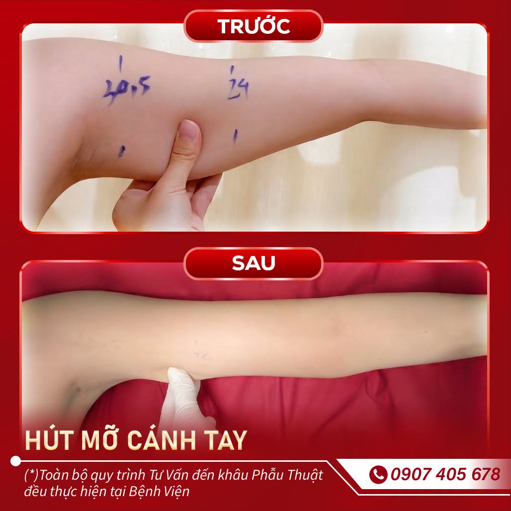 hút mỡ cánh tay 2