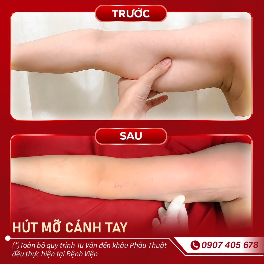 hút mỡ cánh tay 3