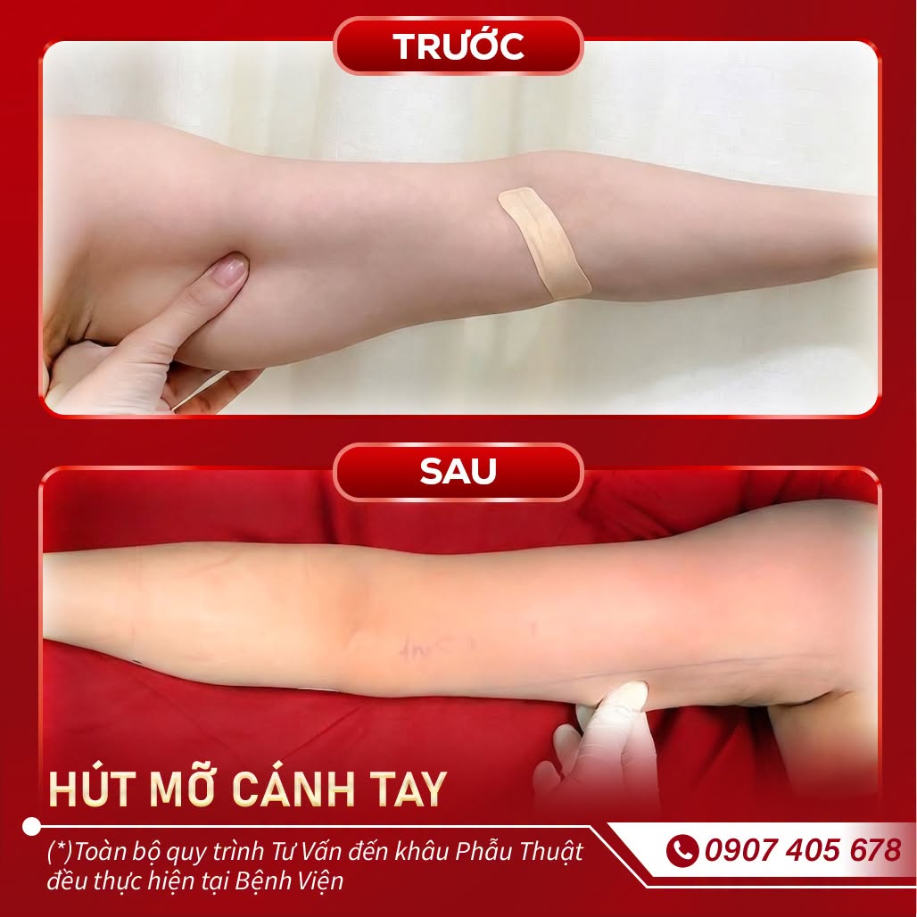 hút mỡ cánh tay 4
