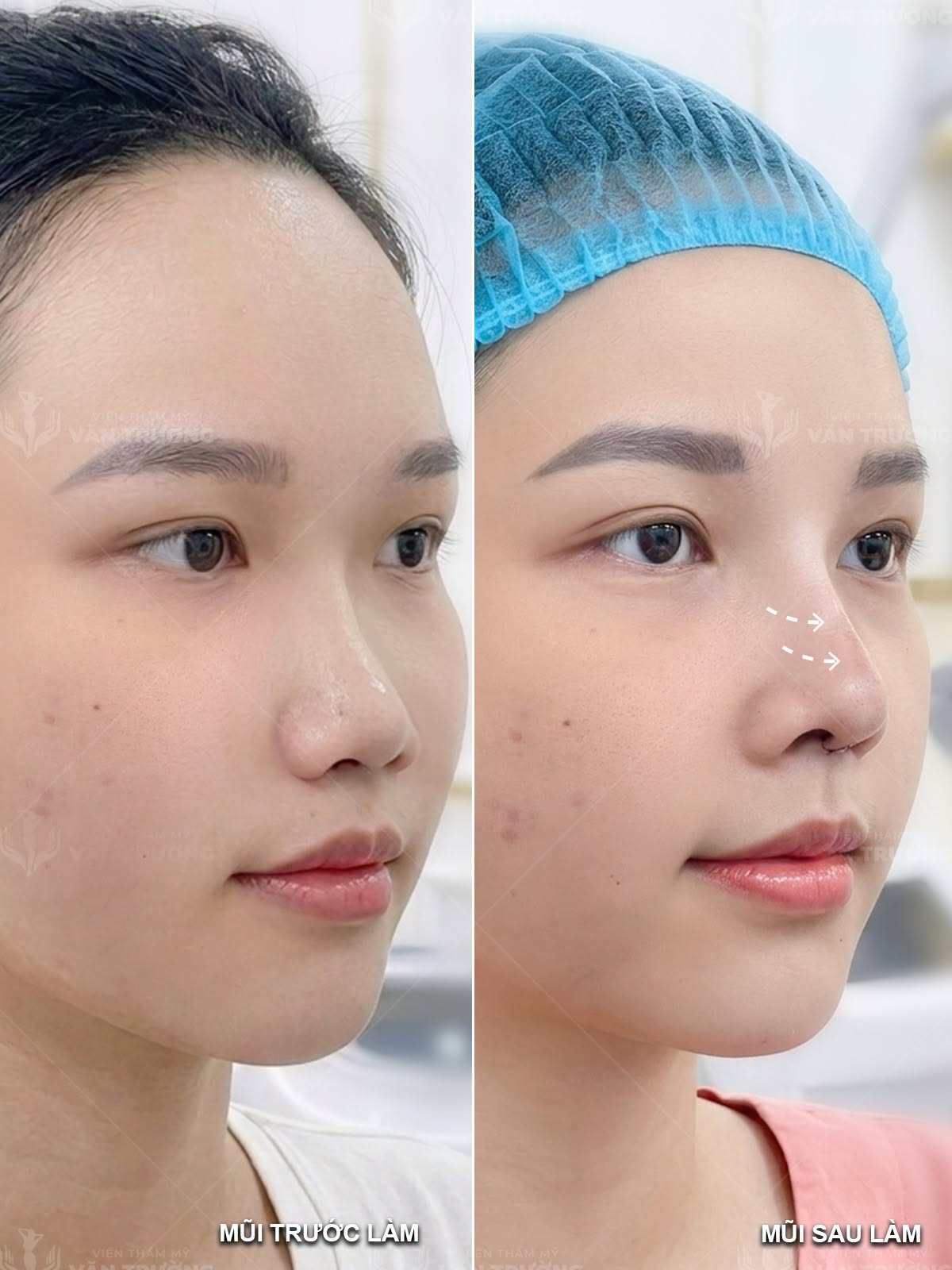 nâng mũi đẹp