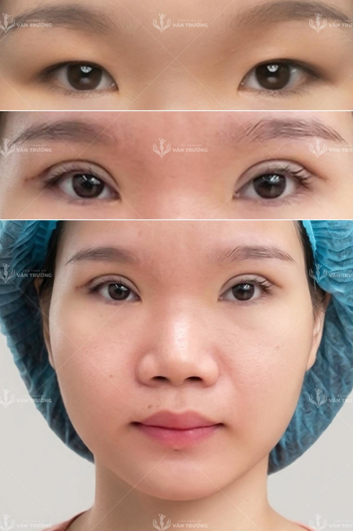 cắt mí đẹp