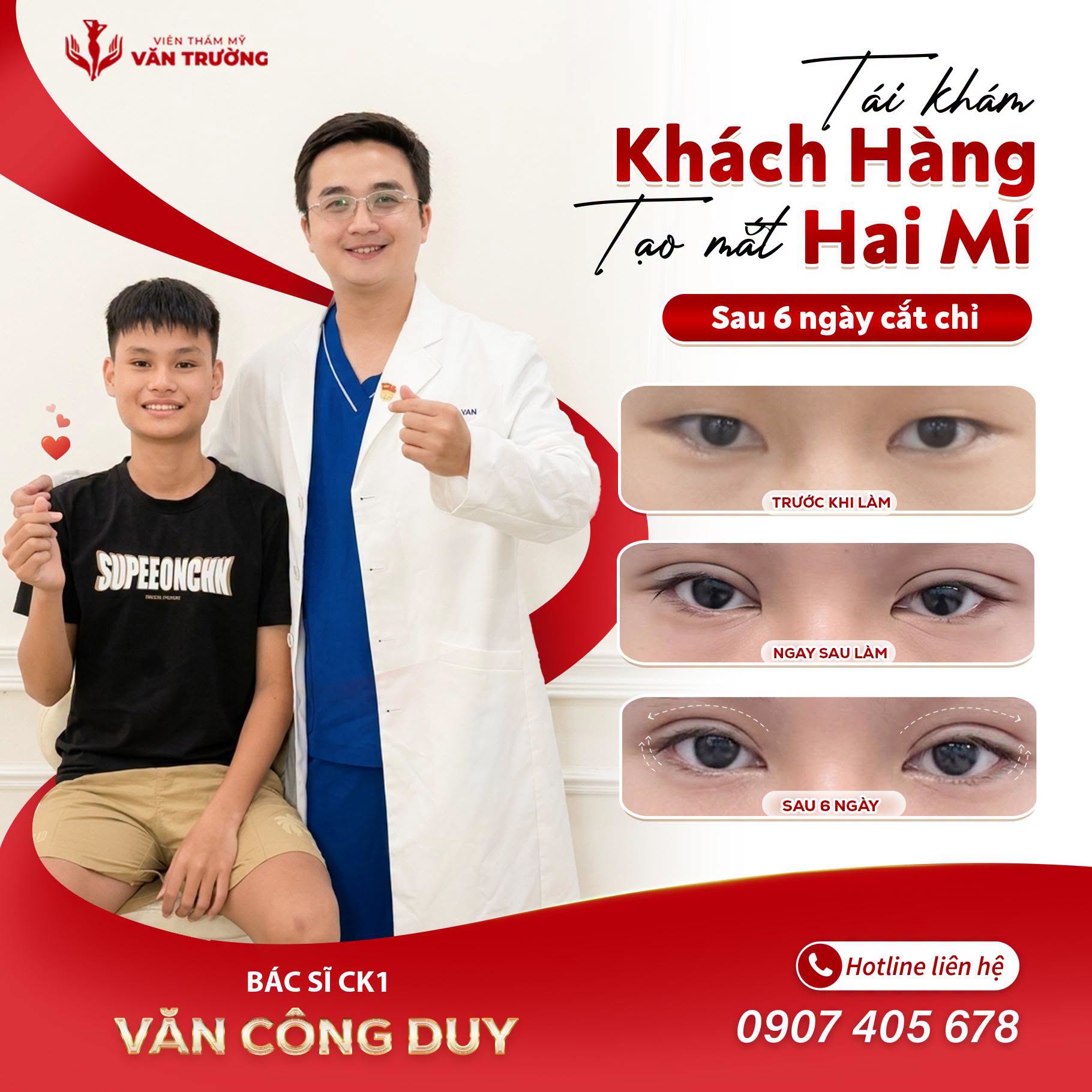 Mắt 2 mí đẹp