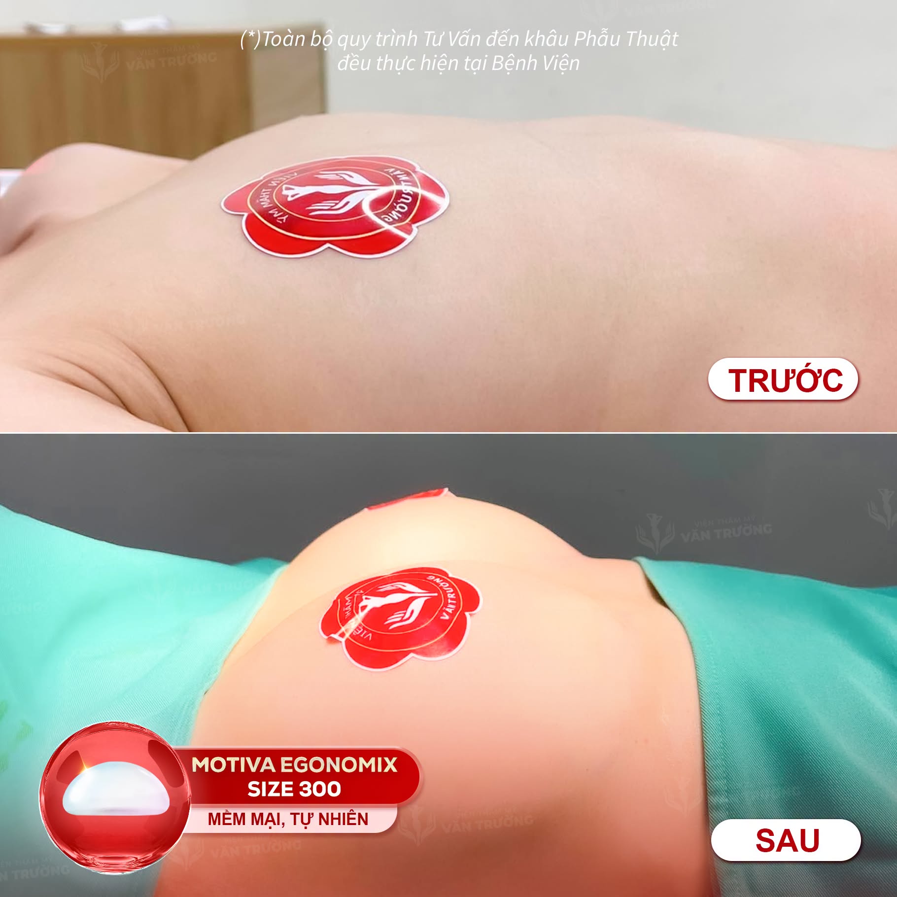 nâng ngực 4