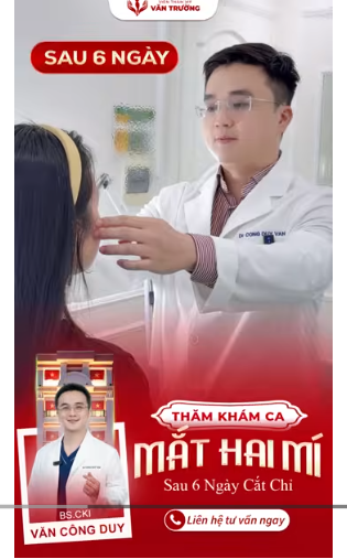 cắt mắt hai mí