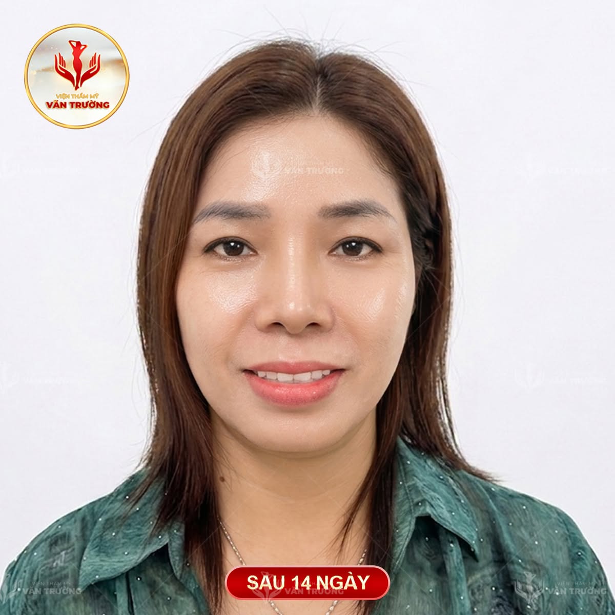 sau nâng mũi