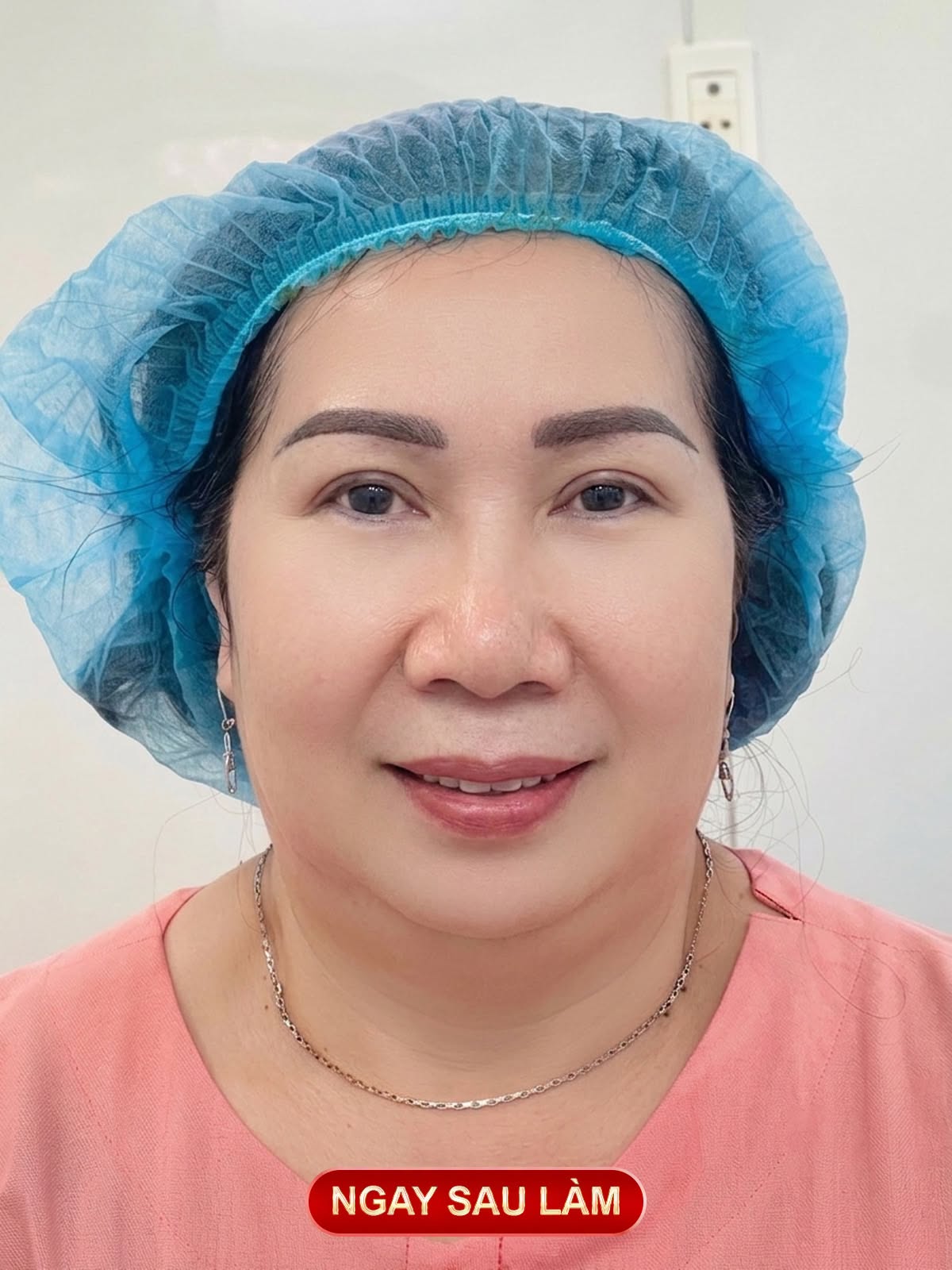 tạo mắt hai mí