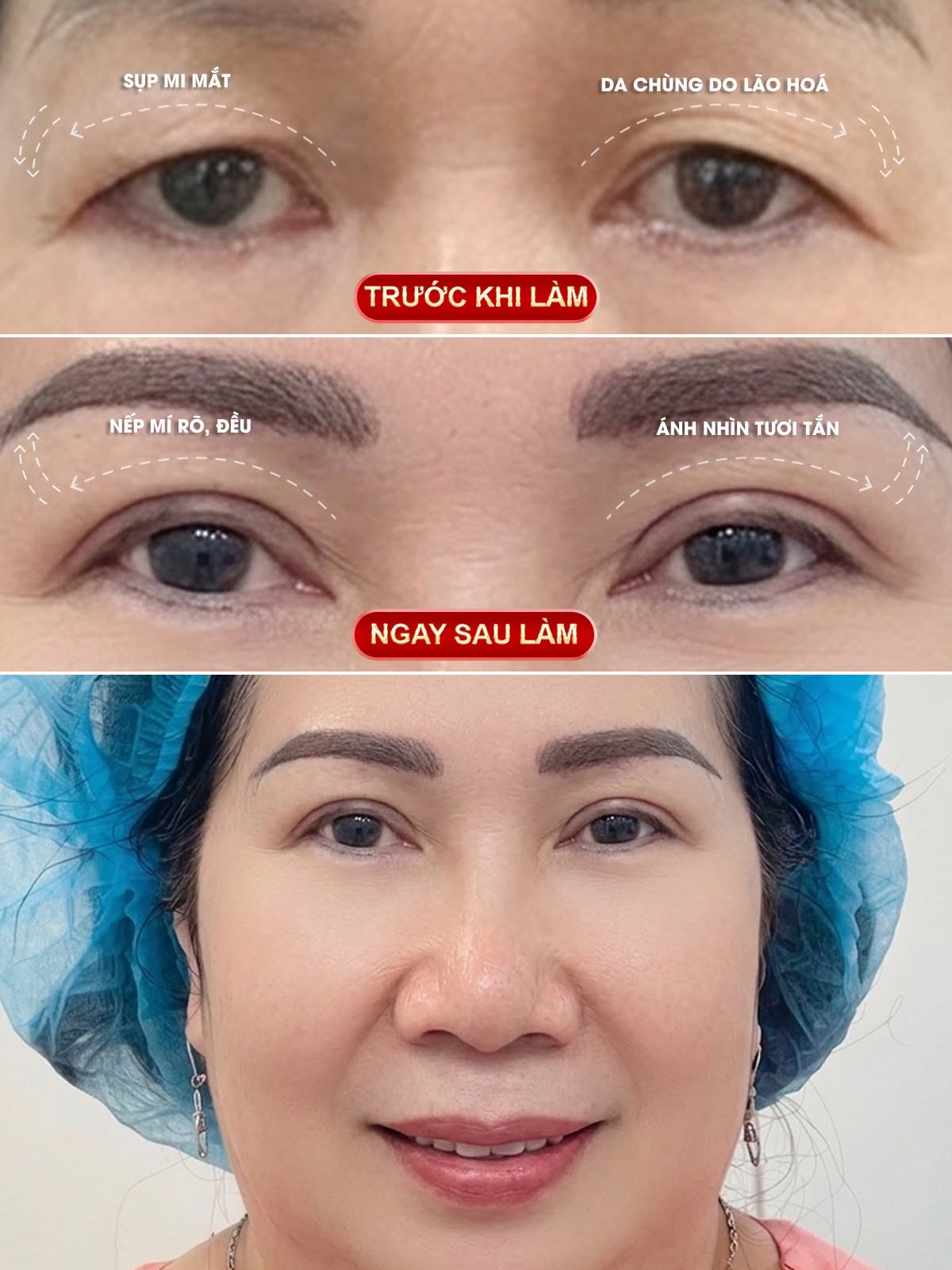 treo cung chân mày và tạo mắt hai mí