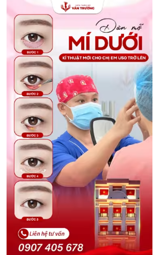 dán mỡ mí dưới