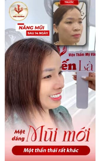 nâng mũi