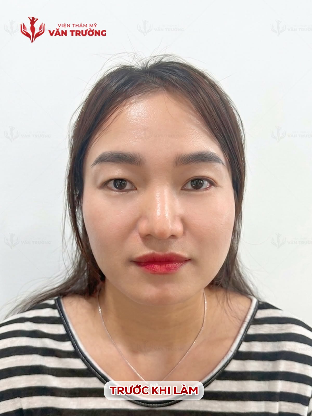 cắt mí 1