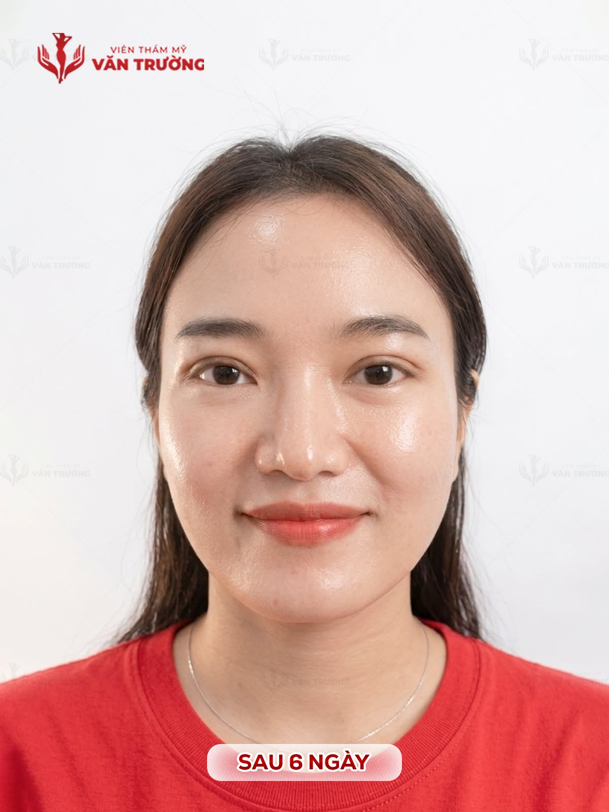Cắt mí đẹp