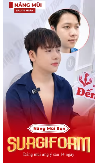 nâng mũi