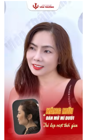 nâng mũi