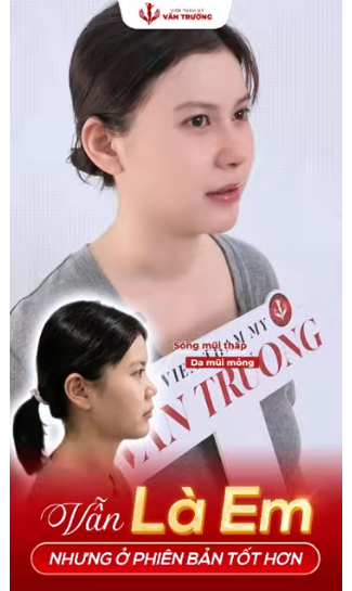 nâng mũi đẹp