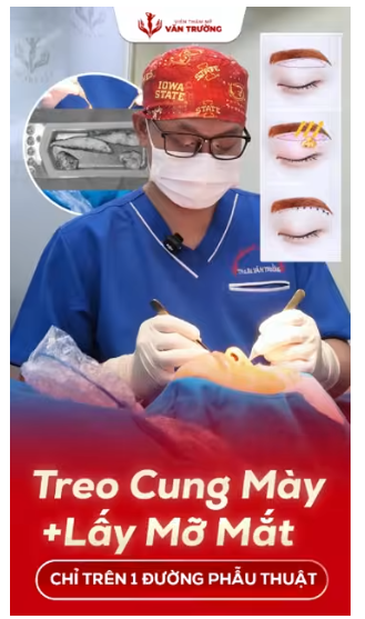 treo cung mày