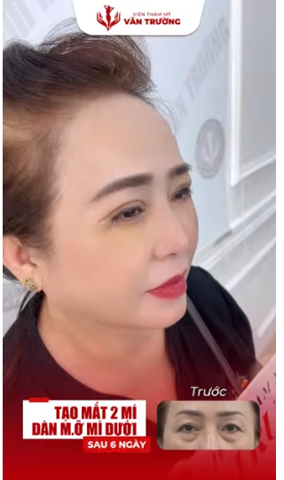 tạo mắt 2 mí