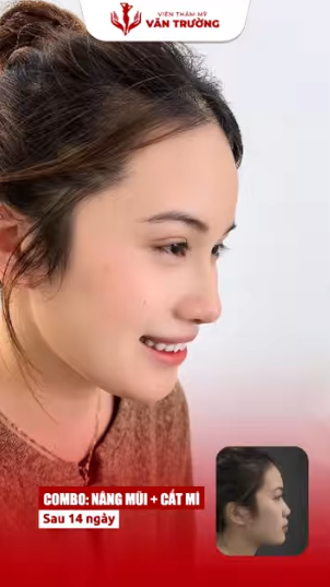 nâng mũi